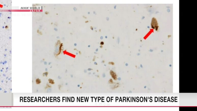 Researchers say they found new type of Parkinson's disease