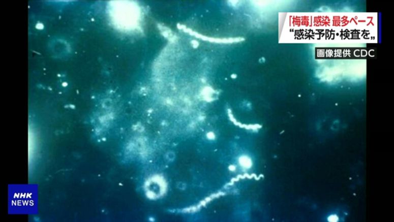 Syphilis cases surging in Japan