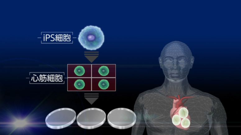iPS-derived heart cell transplant conducted in Tokyo